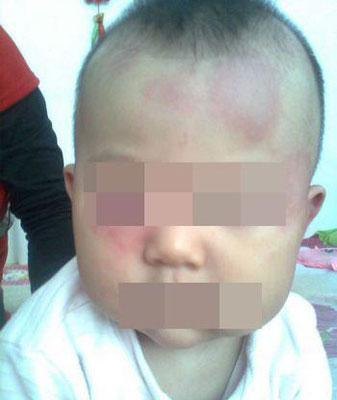 黑新闻：多美滋疑致婴儿皮肤过敏长红斑(图)