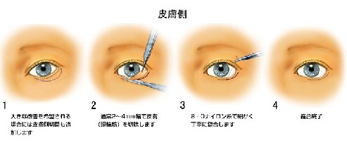 日本眼睑下至手术过程和效果图
