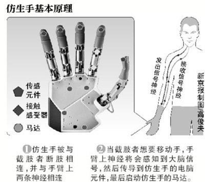 世界首个有触觉仿生手将被移植